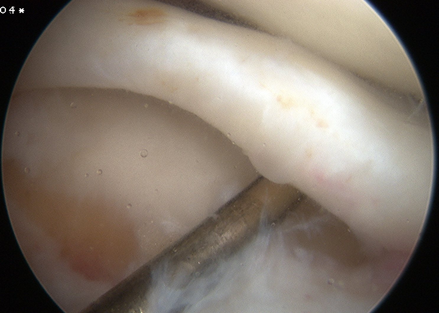 Lateral Meniscus Anterior Horn Tear